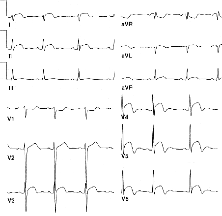 ЭКГ при перикардите