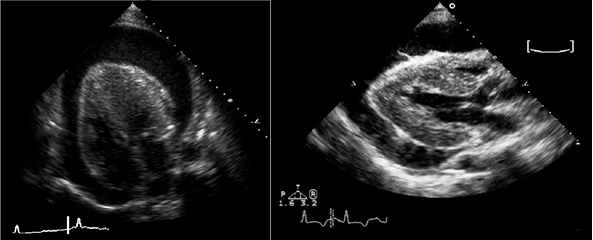 Эхокардиограмма при большом выпоте в перикард