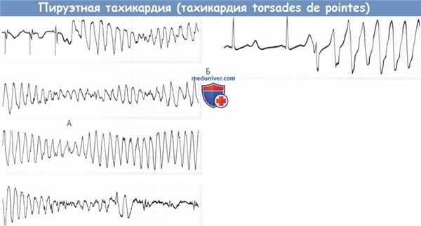 Пируэтная тахикардия - тахикардия torsades de pointes