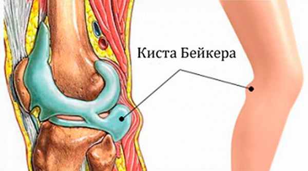 Киста Бейкера