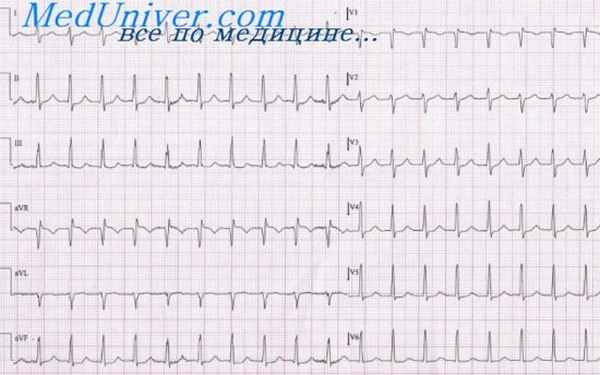 предсердный ритм