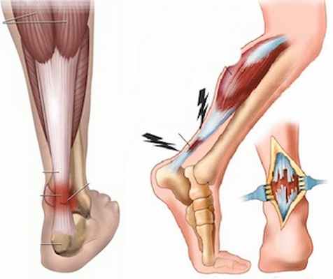Гид по беговым травмам: тендинит ахиллова сухожилия