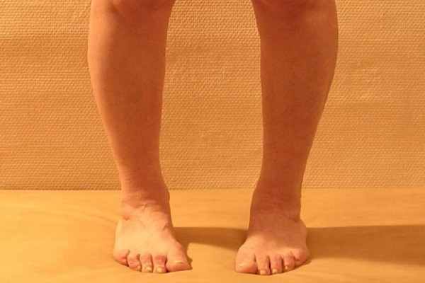 Кoсoлапость