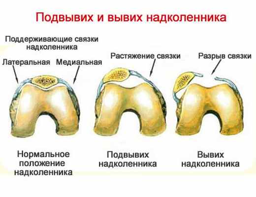 Подвывих и вывих надколенника