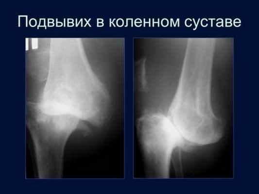 Связки надколенника - лечение травм связок колена