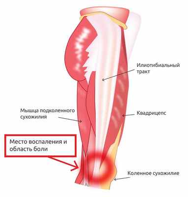 Гид по беговым травмам: синдром подвздошно-большеберцового тракта