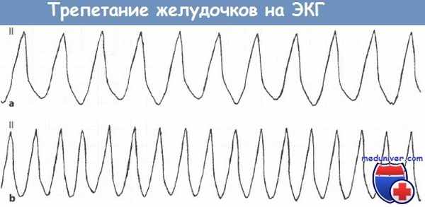Трепетание желудочков на ЭКГ