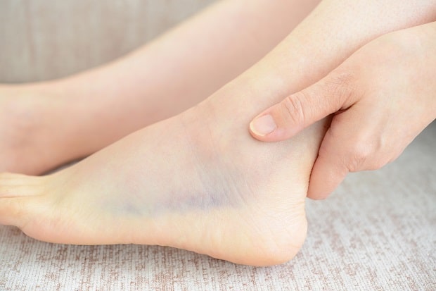 Вывихи стопы лечение