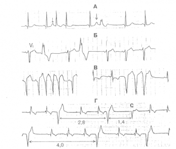 Преждевременные комплексы