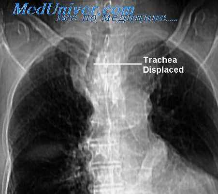 внутригрудной зоб