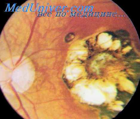 токсоплазмоз