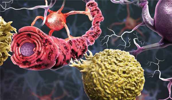 Рассеянный склероз