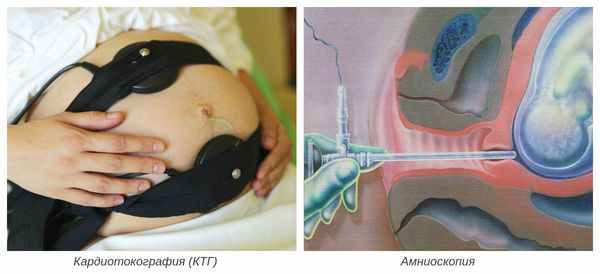 Кардиотокография и амниоскопия