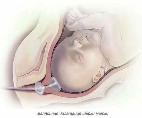 Баллонная дилатация шейки матки