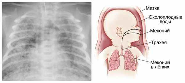 Мекониальная аспирация