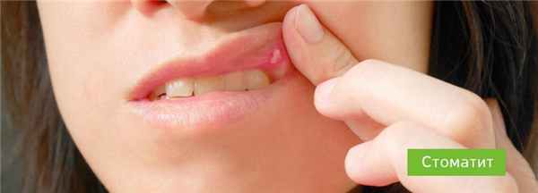 Стоматит: симптомы, виды и методы лечения