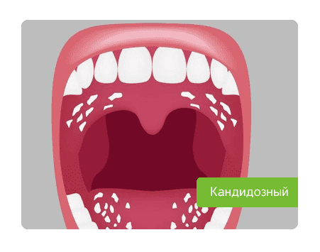 кандидозный стоматит