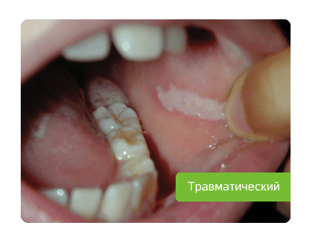 травматический стоматит