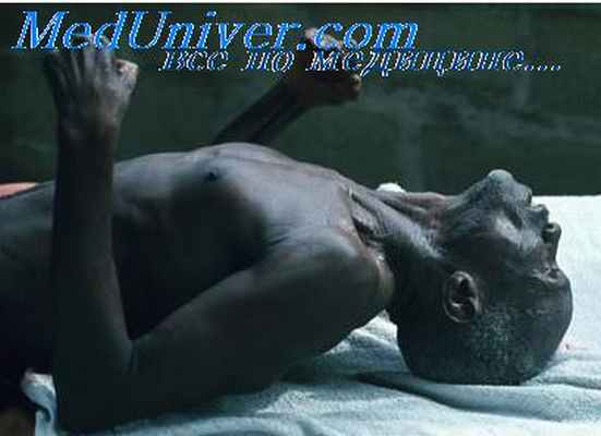 столбняк у пациента