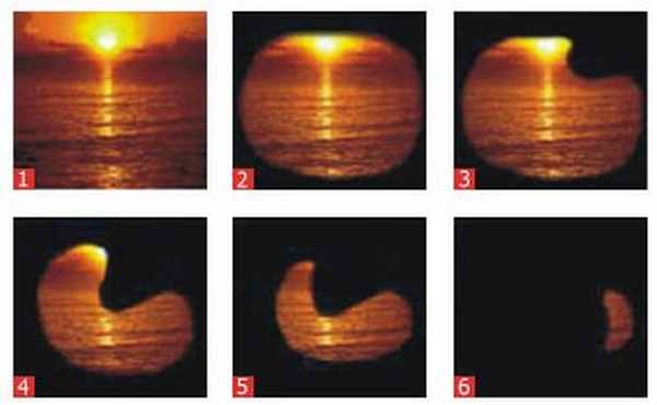 Атрофия зрительного нерва