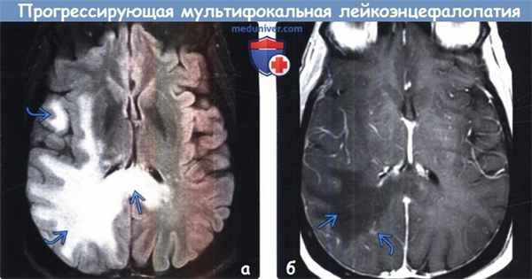 Прогрессирующая мультифокальная лейкоэнцефалопатия на МРТ