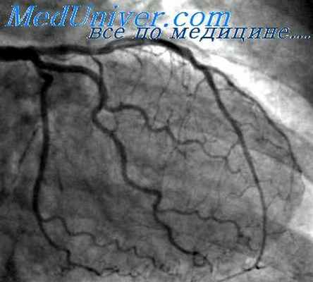 ангиография