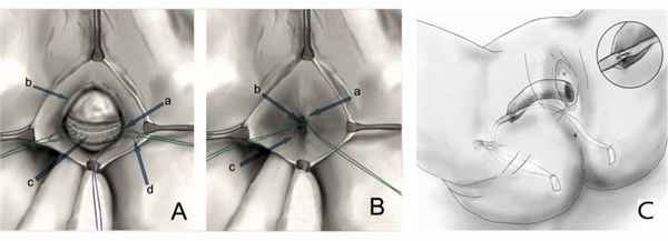 Гибридная реконструкция тазового дна после удаления матки.jpg