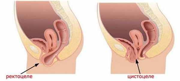 цистоцеле и ректоцеле.jpg