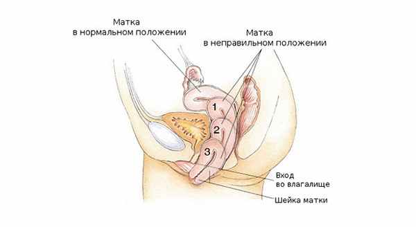 степень пролапса_.jpg
