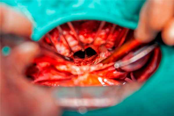 Пролапс митрального клапана