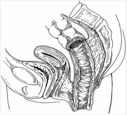 Выпадение прямой кишки фото
