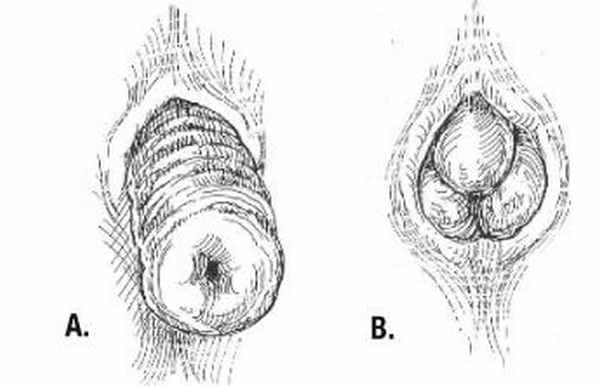Выпадение прямой кишки