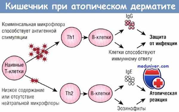 Кишечник при атопическом дерматите