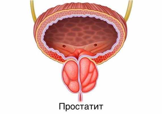 простатит