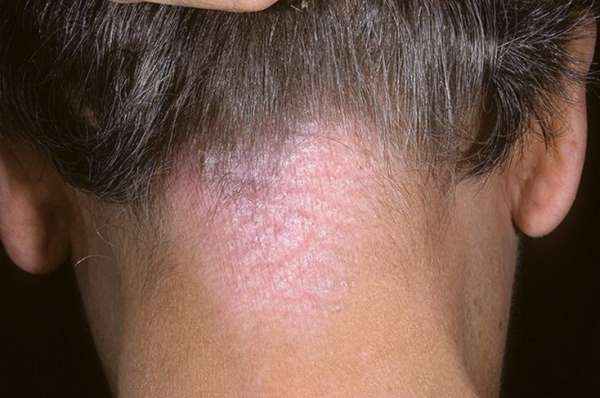 Лишай Видаля: возможные причины появления, способы передачи, симптомы, методы терапии, фото и отзывы