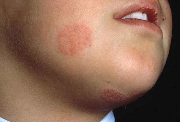 Народные средства от лишая. Лечение лишая у человека в домашних условиях