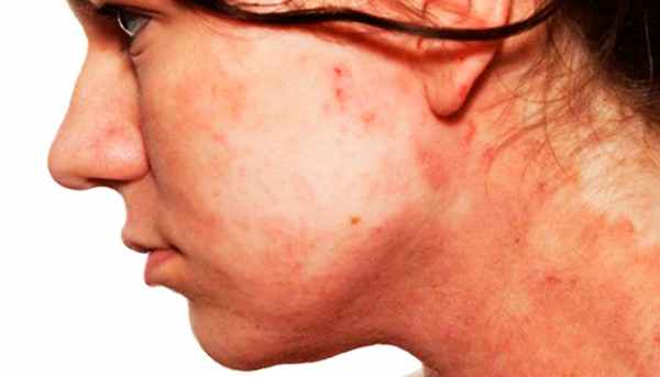 Нейродермит на лице