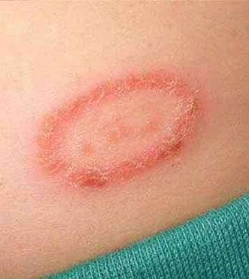 Лишай - что это - и как с ним бороться?