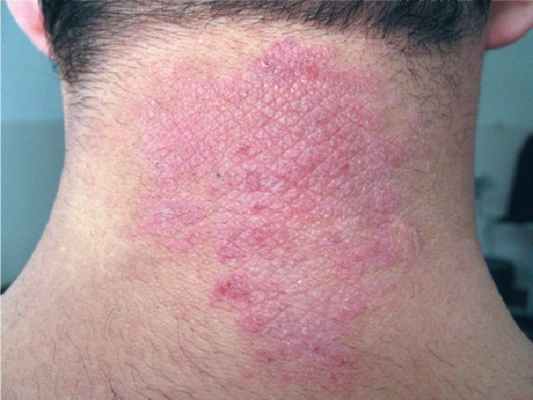 Нейродермит на шее