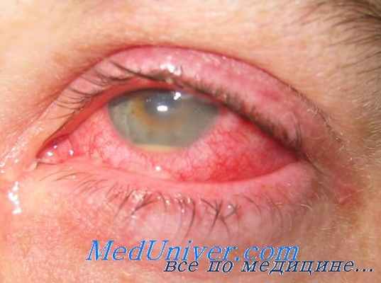 противовоспалительная терапия при эндофтальмите