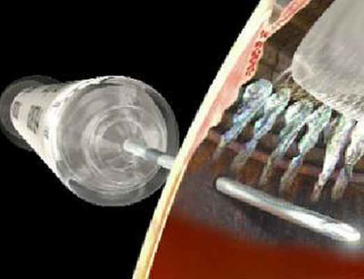 Интравитреальное введение лекарственных препаратов