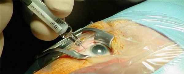 Интравитреальные инъекции в Москве