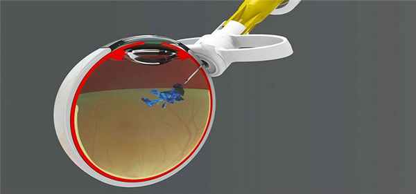 Интравитреальное введение луцентиса в Москве