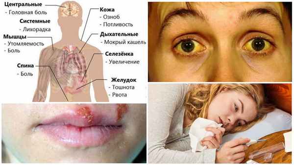 Симптомы малярии