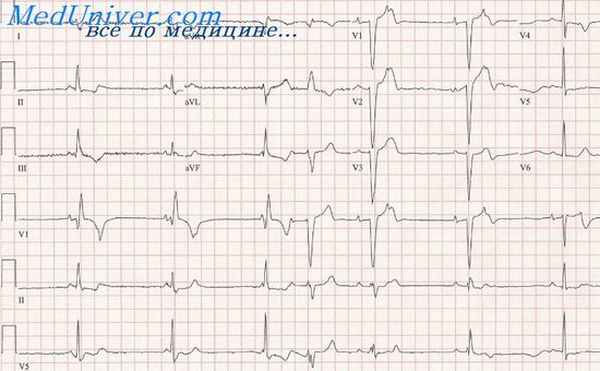 пароксизмальная тахикардия