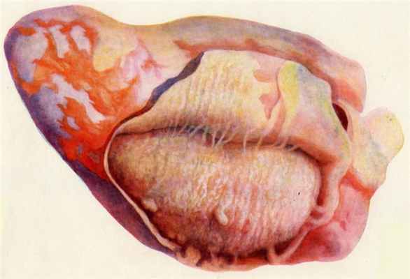 гнойный перикардит