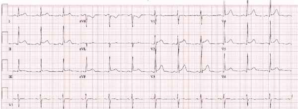 ЭКГ при перикардите