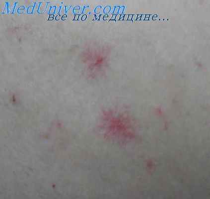 ангиосаркома