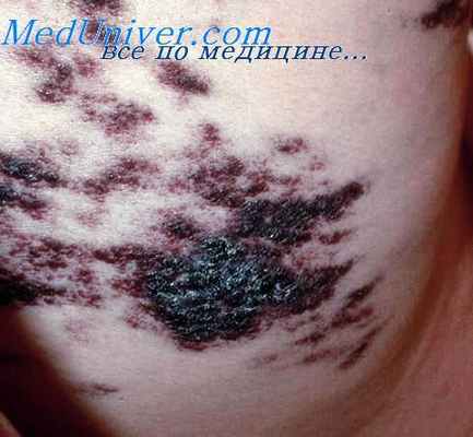 Псевдосаркома Капоши