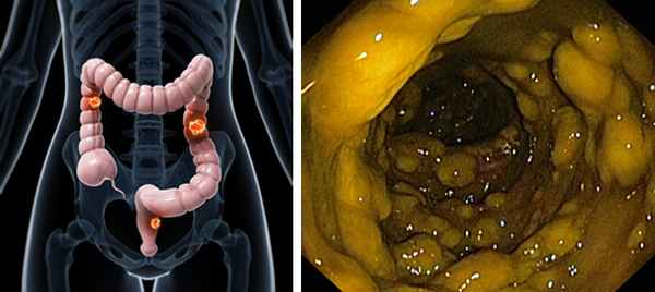 Псевдомембранозный колит